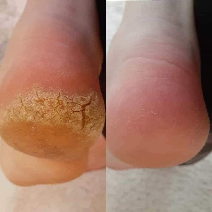 Nano-Glass Foot Filer